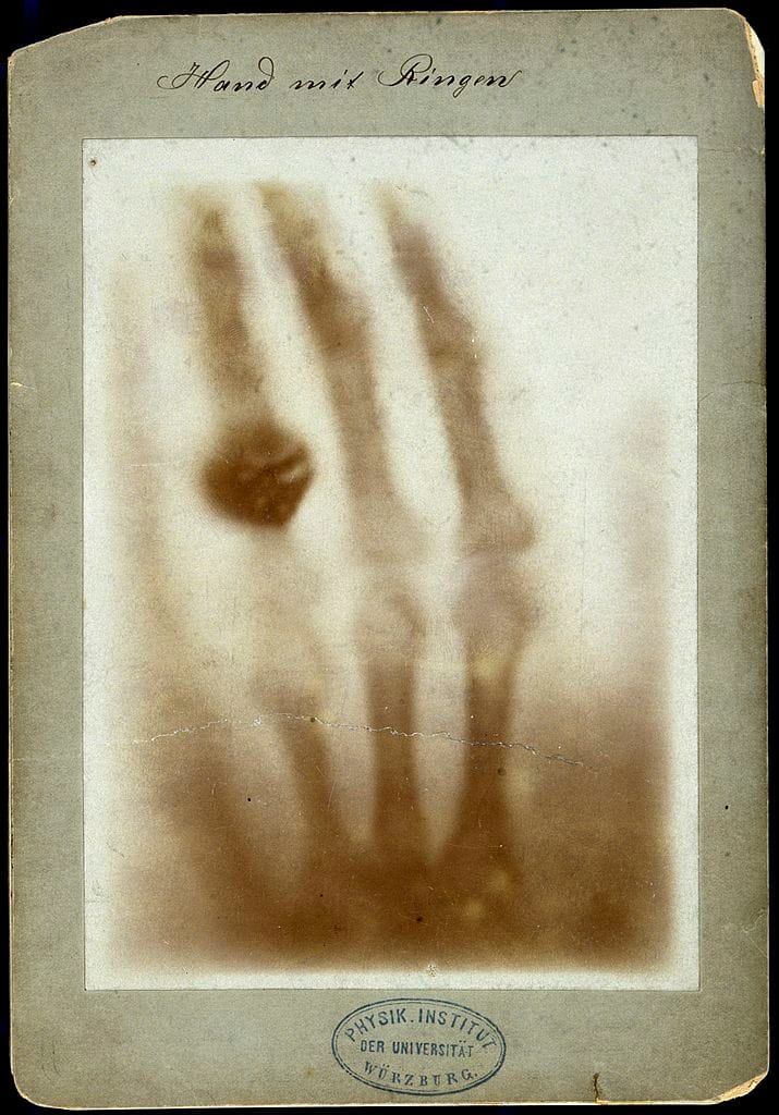 X-ray image of a human hand wearing rings on one finger